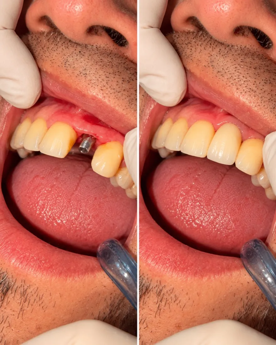 Antes y después: reposición de diente frontal superior sobre implante