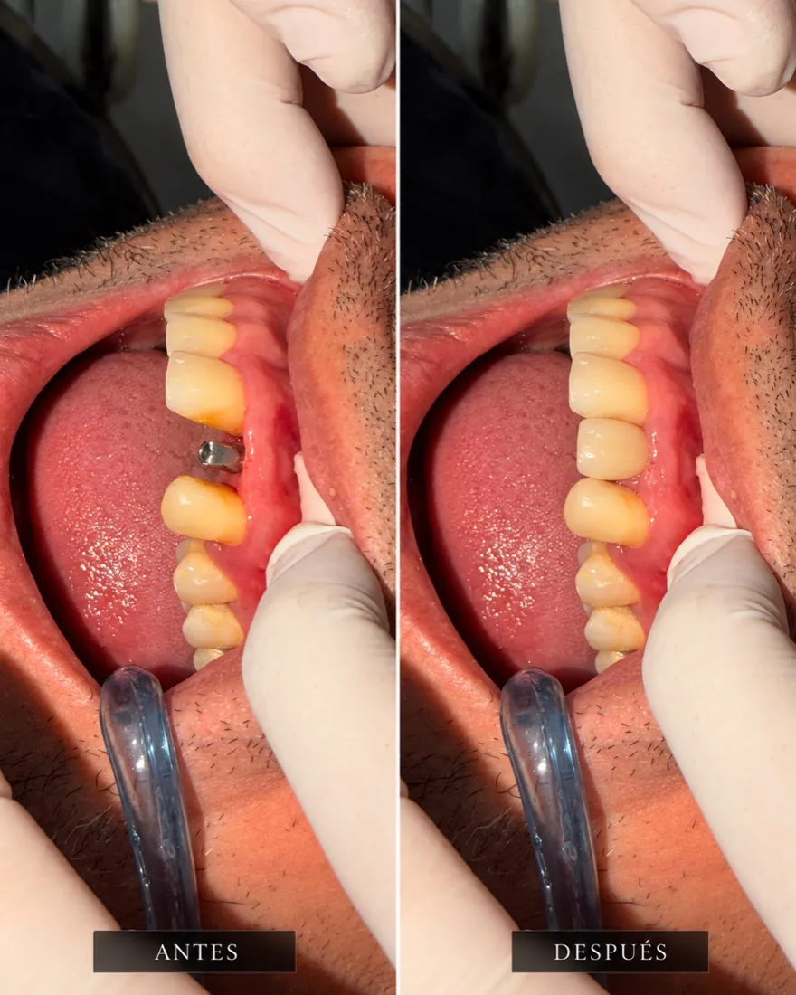 Antes y después: implante en premolar superior con corona definitiva